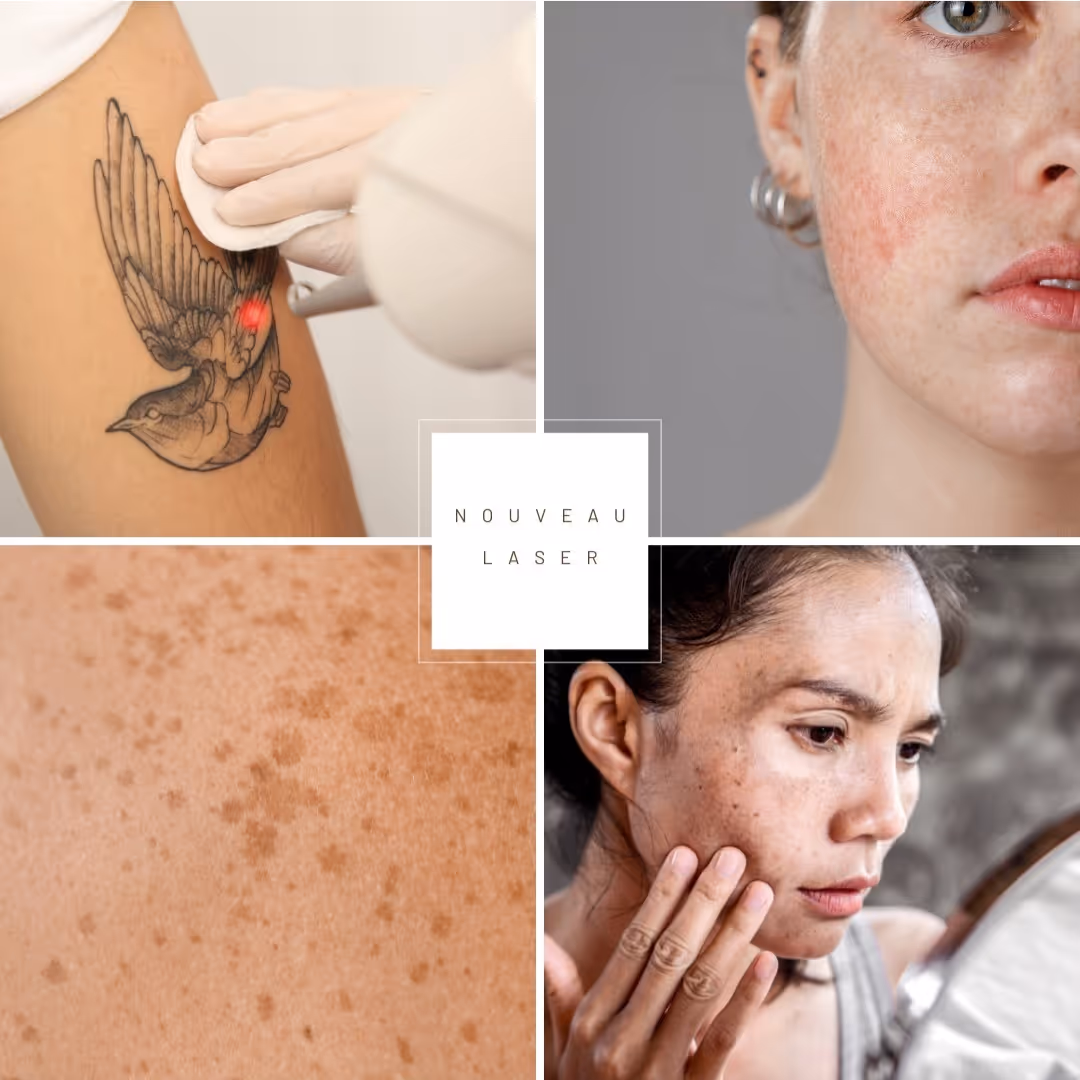 Collage montrant un traitement au laser sur un tatouage, une peau avec des taches et deux visages féminins avec des taches de pigmentation rougeâtres.